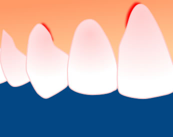 Zahnfleischbluten